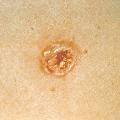 skin-cancer-mole-carcinoma