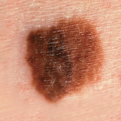 melanoma-skin-cancer