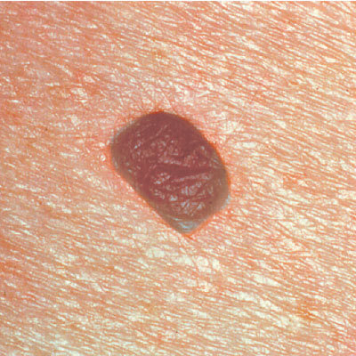 skin-cancer-mole