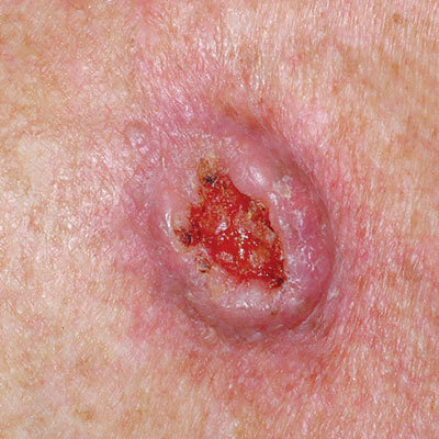 skin-cancer-mole-carcinoma